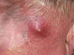 abscess carbuncle bite spider infection bacterial cellulitis neck boil disease treatment skin abscesses lumps boils part different body furuncle cause